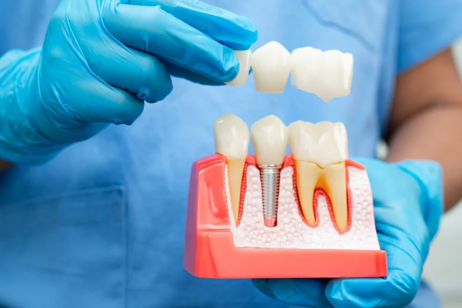 Visual showing how dental implants work