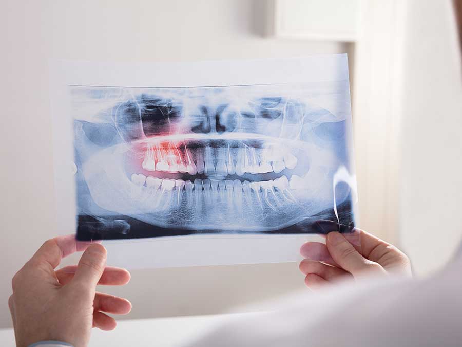 costs of wisdom teeth removal