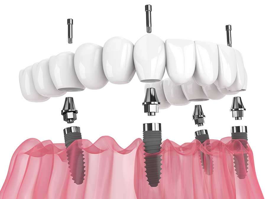 right type of dental implants